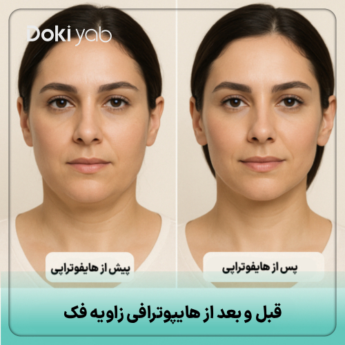 مقایسه شبیه‌سازی‌شده قبل و بعد از زاویه سازی فک با هایفوتراپی