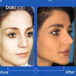 نمونه عمل بینی دکتر عطاالله حیدری جراح بینی تهران