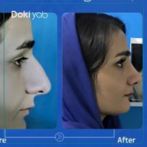 جراحی بینی با دکتر عطااله حیدری در تهران