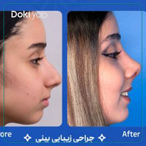 نمونه جراحی بینی دکتر عطاالله حیدری در تهران