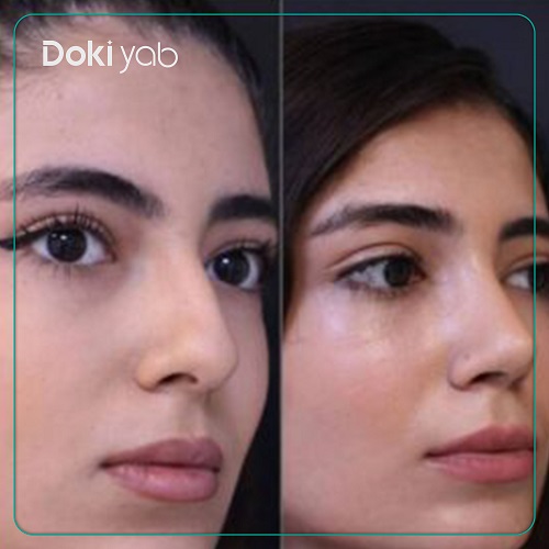 نمونه عمل بینی استخوانی دکتر حمید نوری جراح بینی در تهران