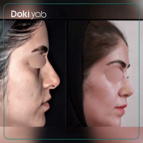 عکس قبل و بعد عمل بینی دخترانه در تهران با دکتر شهریار یحیوی، تیم دکی یاب