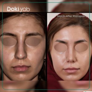قبل و بعد از عمل بینی استخوانی قوزدار در تهران با دکتر یحیوی، مرکز دکی یاب