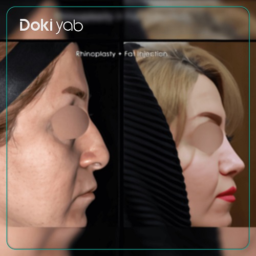 نمونه جراحی بینی دکتر شهریار یحیوی در تهران