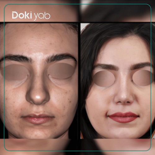 نمونه جراحی بینی دکتر شهریار یحیوی در تهران