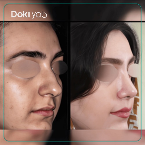 نمونه کار دکتر یحیوی جراح بینی درتهران