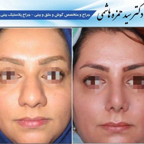 قبل و بعد جراحی بینی در شیراز با دکتر حمزه هاشمی