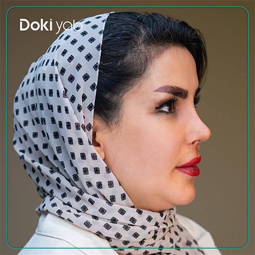 نمونه کار عمل بینی فانتزی توسط دکتر حمزه هاشمی در شیراز