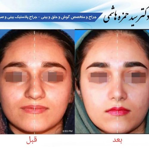 عمل بینی با دکتر حمزه هاشمی در شیراز، دکی یاب
