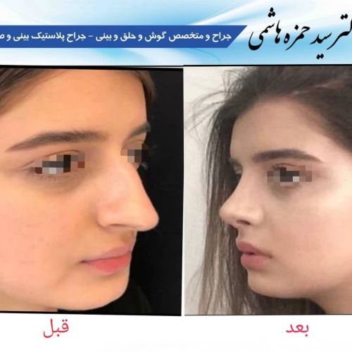 عکس عمل بینی دکتر حمزه هاشمی جراح بینی در شیراز