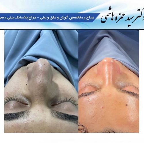 عمل بینی گوشتی شدید با دکتر حمزه هاشمی جراح بینی در شیراز
