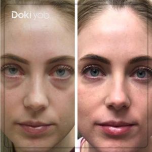 فیلر زیر چشم ۲۰۲۵: ماندگاری، عوارض، برندها و چه کسانی نباید تزریق کنند؟