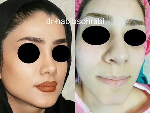 نمونه کار عمل بینی دکتر حبیب سهرابی جراح بینی تهران