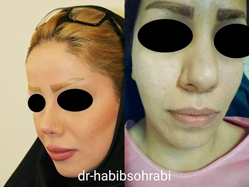 نمونه جراحی بینی دکتر حبیب سهرابی جراح بینی تهران