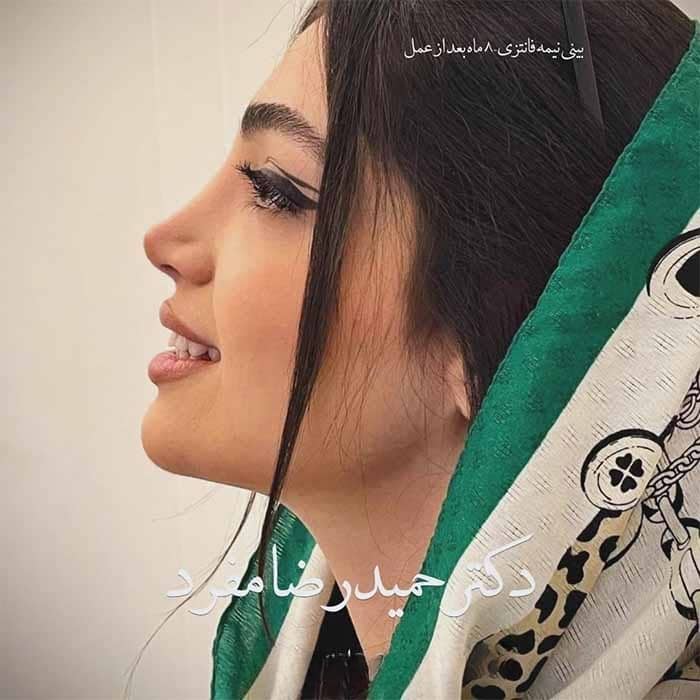 نمونه کار دکتر حمیدرضا مفرد جراح بینی در تهران