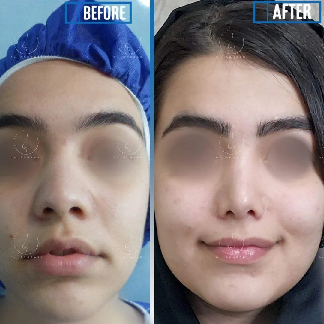 نمونه کار دکتر حبیب سهرابی جراح بینی تهران