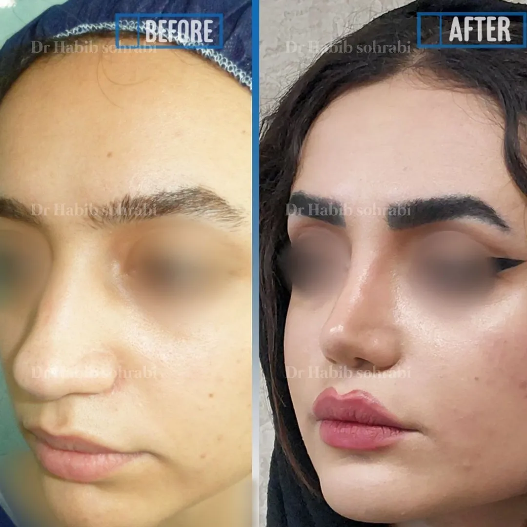 نمونه کار دکتر حبیب سهرابی جراح بینی تهران
