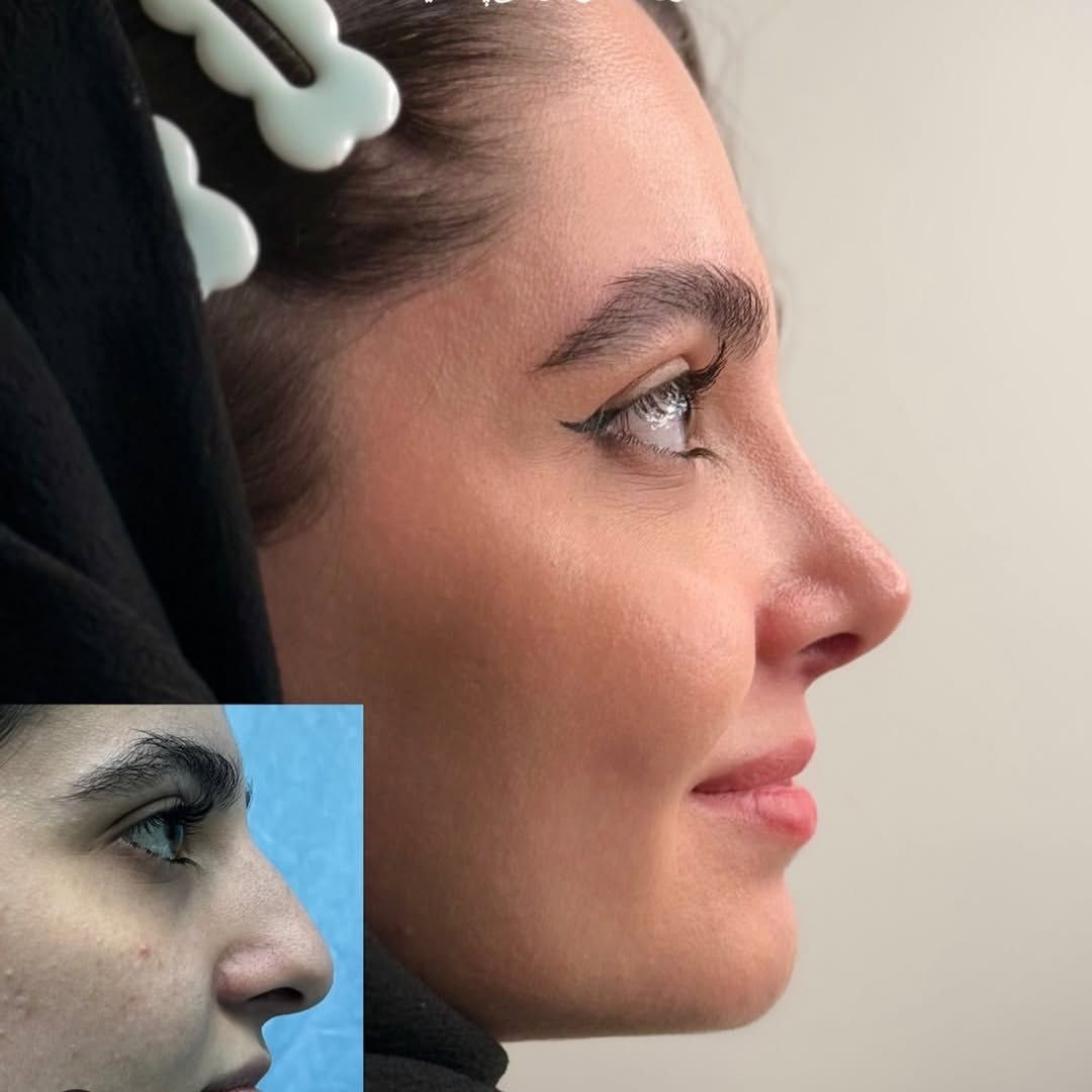 نمونه کار دکتر حمیدرضا مفرد جراح بینی تهران