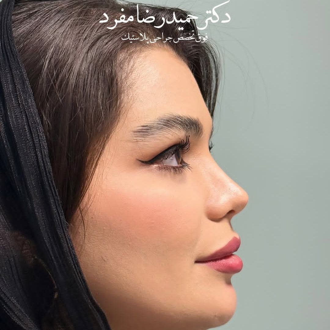 نمونه عمل بینی دکتر حمیدرضا مفرد جراح بینی تهران