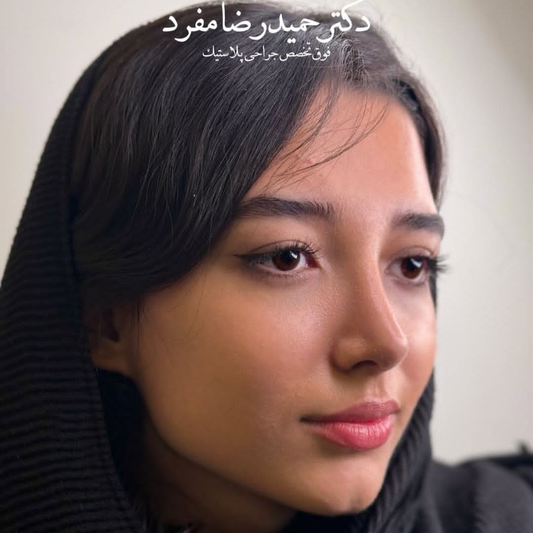 نمونه کار دکتر حمیدرضا مفرد جراح بینی در تهران