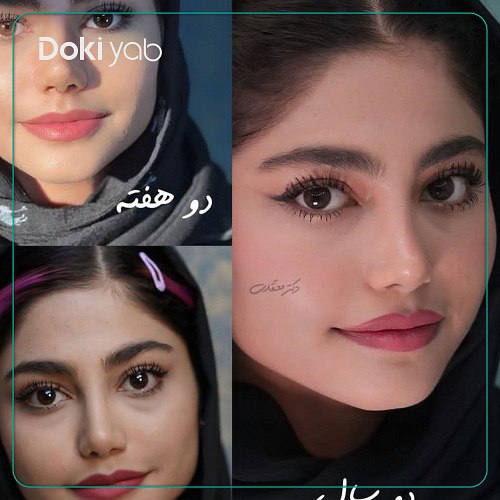 نمونه عمل بینی دکتر معتقدی جراح بینی در تهران