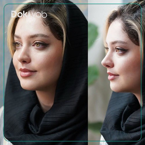 نمونه کار عمل بینی دکتر بابک معتقدی در تهران