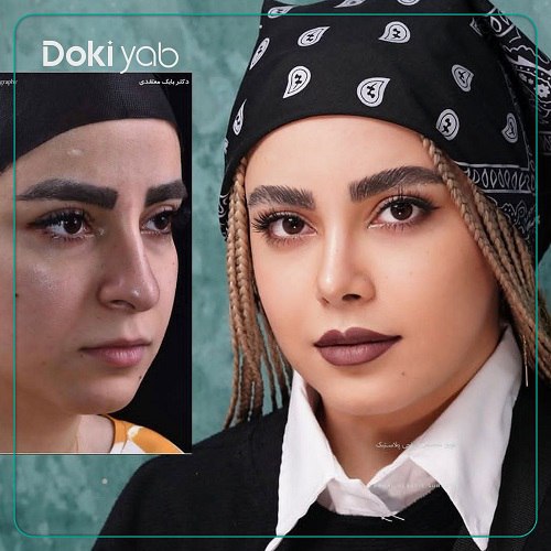 جراحی بینی با دکتر بابک معتقدی در تهران