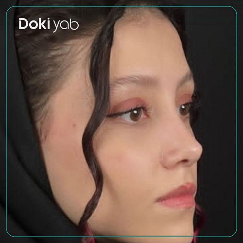 نمونه کار جراحی بینی دکتر فرزان رضایی در تهران