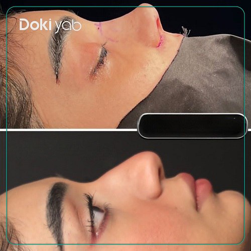 نمونه کارعمل بینی دکتر فرزان رضایی جراح بینی تهران