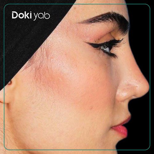 نمونه کار عمل بینی دکتر سام تویسرکانی در تهران