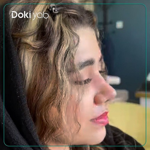 نمونه عمل بینی با دکتر حسام اسکندرزاده جراح بینی در تهران