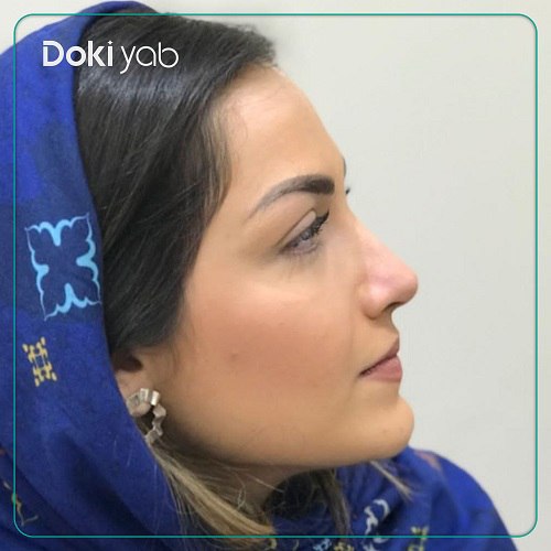 نمونه عمل بینی دکتر علی زینلی در تهران