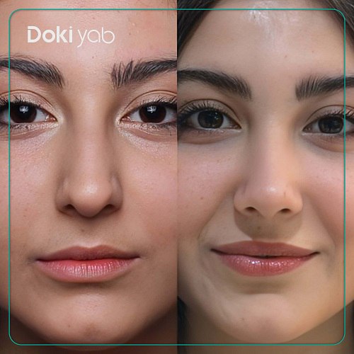 نمونه جراحی بینی دکتر افلاکی در تهران