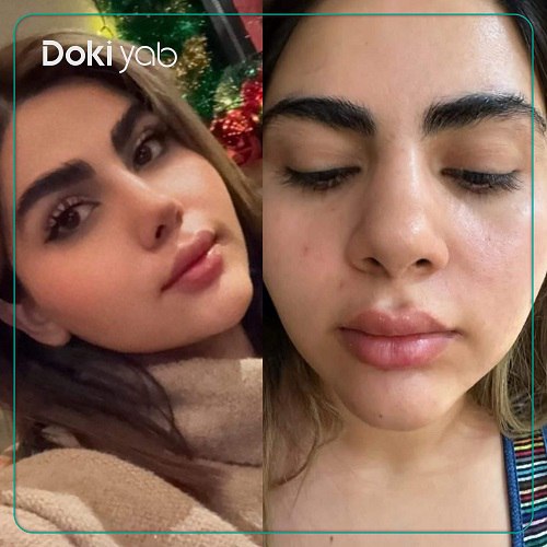 جراحی بینی با دکتر پوریا افلاکی در تهران
