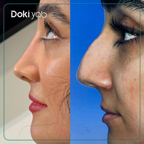 نمونه کار دکتر پوریا افلاکی جراح بینی تهران
