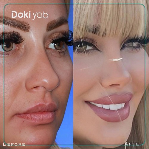 نمونه کار دکتر پوریا افلاکی جراح بینی تهران