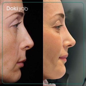 نمونه عمل بینی دکتر پوریا افلاکی جراح بینی تهران