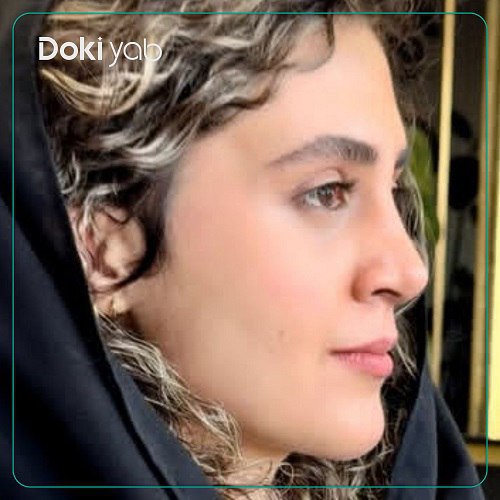 نمونه جراحی بینی دکتر امید ثابت مهر در تهران