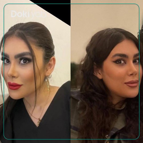 نمونه عمل بینی دکتر امید ثابت مهر در تهران