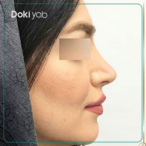 عمل بینی دکتر امید ثابت مهر جراح بینی در تهران