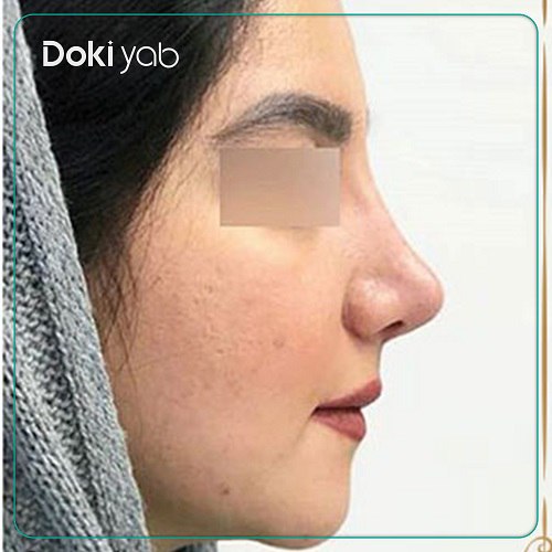 نمونه کار دکتر امید ثابت مهر جراح بینی در تهران