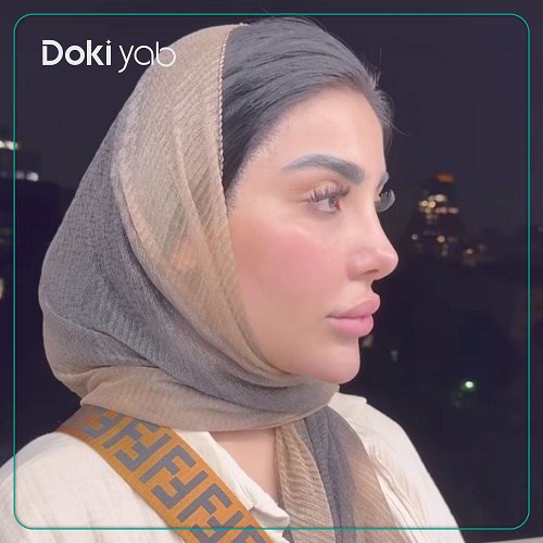نمونه کار عمل بینی دکتر امید ثابت مهر در تهران