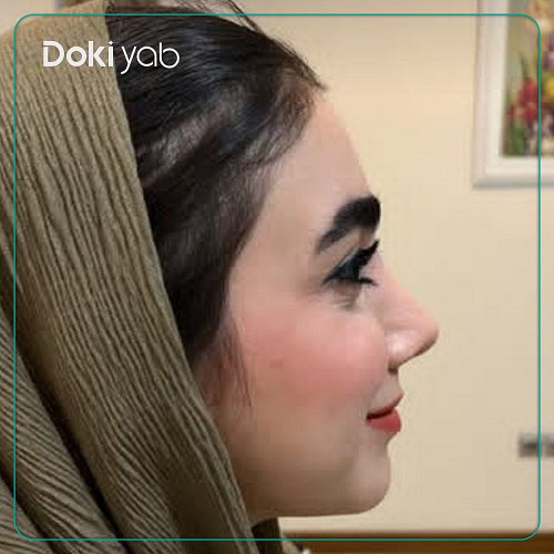نمونه عمل بینی دکتر آزاده کازرونی جراح بینی در اصفهان