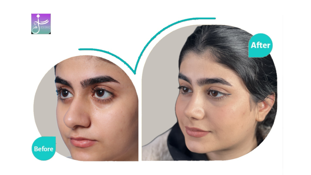نمونه کار عمل بینی دکتر جواد خالقی جراح بینی تهران