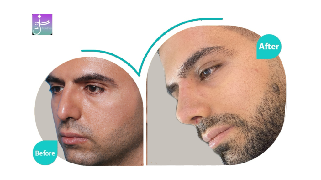 نمونه عمل بینی دکتر جواد خالقی جراح بینی تهران