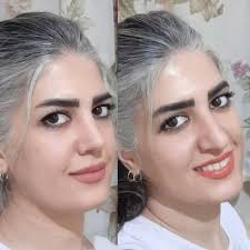 نمونه جراحی بینی دکتر علیرضا سلطانی فر