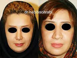 نمونه کار دکتر حبیب سهرابی جراح بینی در تهران