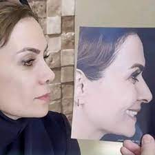 نمونه کار عمل بینی دکتر محمدحسین طاهریان جراح بینی در تهران