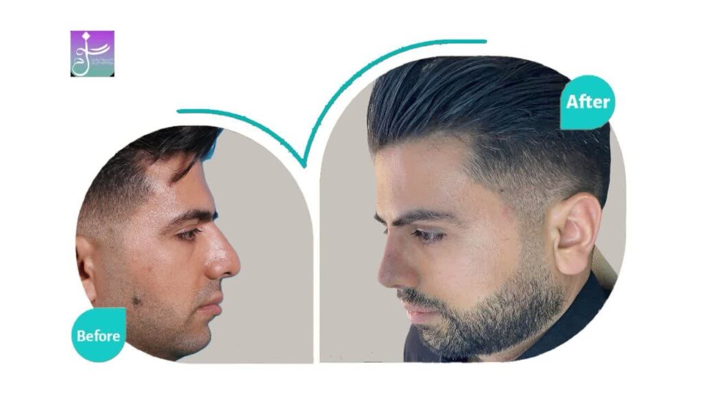 نمونه جراحی بینی دکتر جواد خالقی جراح بینی در تهران