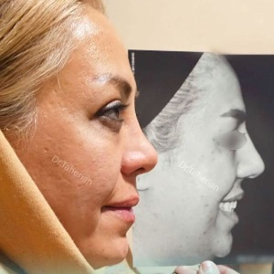 نمونه عمل بینی دکتر محمدحسین طاهریان جراح بینی تهران